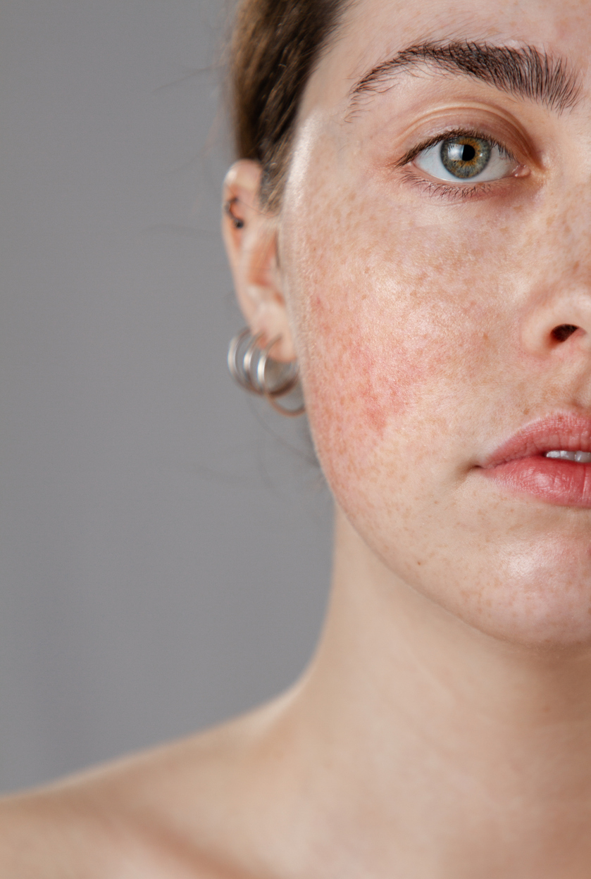 kvinna med rosacea